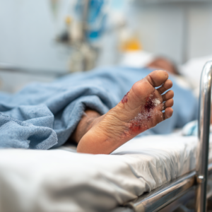 ulcered foot
